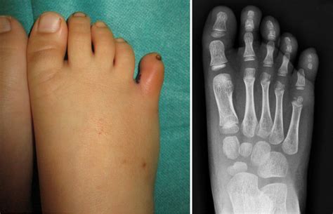 stubbed toe vs broken toe kid